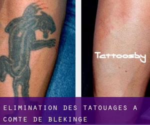 Élimination des tatouages à Comté de Blekinge