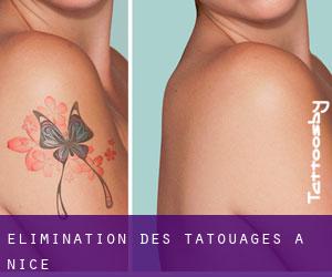 Élimination des tatouages à Nice