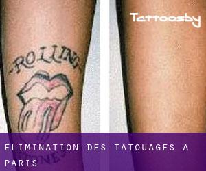 Élimination des tatouages à Paris