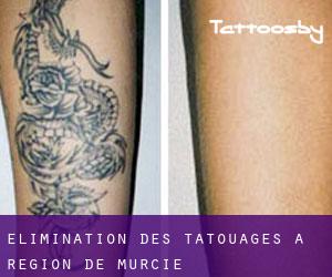 Élimination des tatouages à Région de Murcie