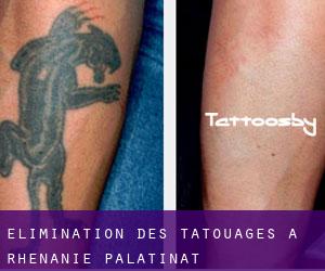 Élimination des tatouages à Rhénanie-Palatinat