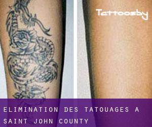 Élimination des tatouages à Saint John County