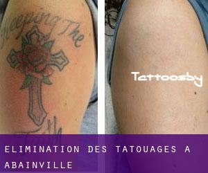 Élimination des tatouages à Abainville