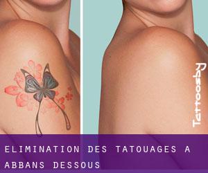 Élimination des tatouages à Abbans-Dessous