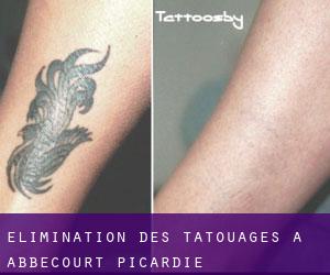 Élimination des tatouages à Abbecourt (Picardie)