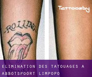 Élimination des tatouages à Abbotspoort (Limpopo)