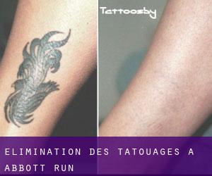 Élimination des tatouages à Abbott Run