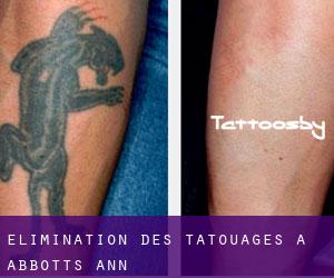 Élimination des tatouages à Abbotts Ann