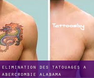 Élimination des tatouages à Abercrombie (Alabama)