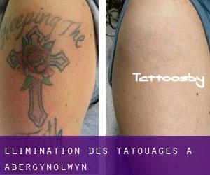 Élimination des tatouages à Abergynolwyn