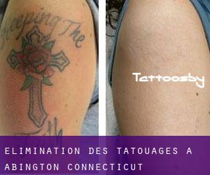 Élimination des tatouages à Abington (Connecticut)