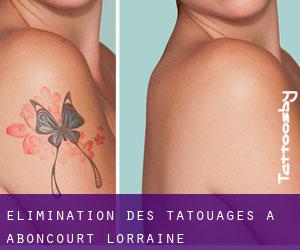 Élimination des tatouages à Aboncourt (Lorraine)