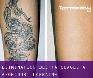 Élimination des tatouages à Aboncourt (Lorraine)