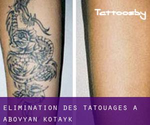 Élimination des tatouages à Abovyan (Kotaykʼ)