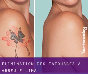 Élimination des tatouages à Abreu e Lima