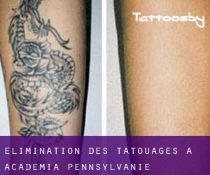Élimination des tatouages à Academia (Pennsylvanie)