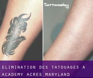Élimination des tatouages à Academy Acres (Maryland)