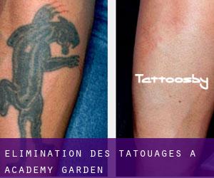 Élimination des tatouages à Academy Garden