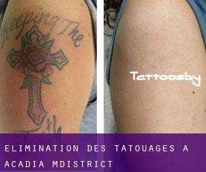Élimination des tatouages à Acadia M.District