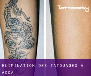Élimination des tatouages à Acca