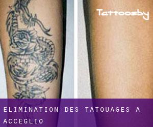 Élimination des tatouages à Acceglio