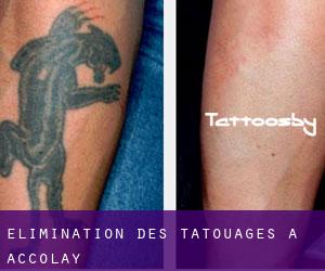 Élimination des tatouages à Accolay
