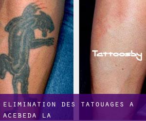 Élimination des tatouages à Acebeda (La)