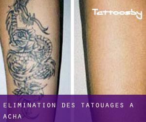 Élimination des tatouages à Acha