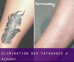 Élimination des tatouages à Achany