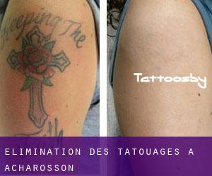 Élimination des tatouages à Acharosson