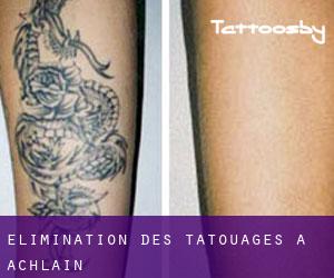 Élimination des tatouages à Achlain