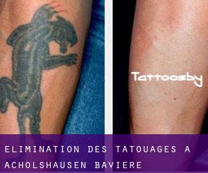 Élimination des tatouages à Acholshausen (Bavière)