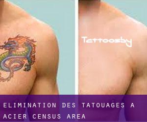 Élimination des tatouages à Acier (census area)
