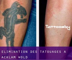Élimination des tatouages à Acklam Wold