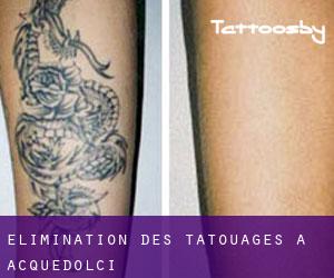 Élimination des tatouages à Acquedolci