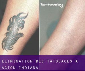 Élimination des tatouages à Acton (Indiana)