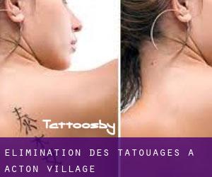 Élimination des tatouages à Acton Village