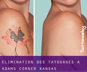 Élimination des tatouages à Adams Corner (Kansas)