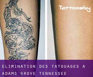 Élimination des tatouages à Adams Grove (Tennessee)