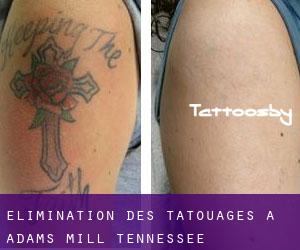 Élimination des tatouages à Adams Mill (Tennessee)