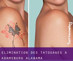 Élimination des tatouages à Adamsburg (Alabama)