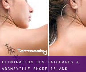 Élimination des tatouages à Adamsville (Rhode Island)