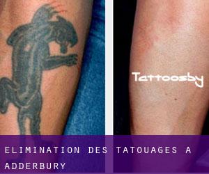 Élimination des tatouages à Adderbury