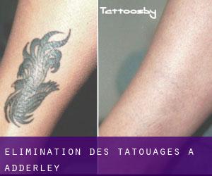 Élimination des tatouages à Adderley