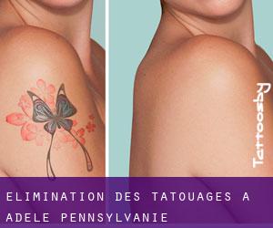 Élimination des tatouages à Adele (Pennsylvanie)