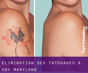 Élimination des tatouages à Ady (Maryland)