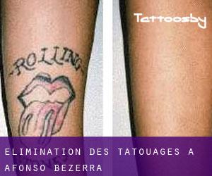 Élimination des tatouages à Afonso Bezerra
