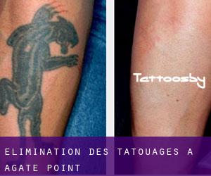 Élimination des tatouages à Agate Point