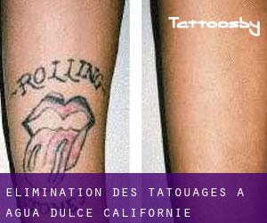 Élimination des tatouages à Agua Dulce (Californie)