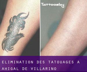 Élimination des tatouages à Ahigal de Villarino